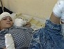 Irak: ein durch eine Streubombe schwer verletzter Junge